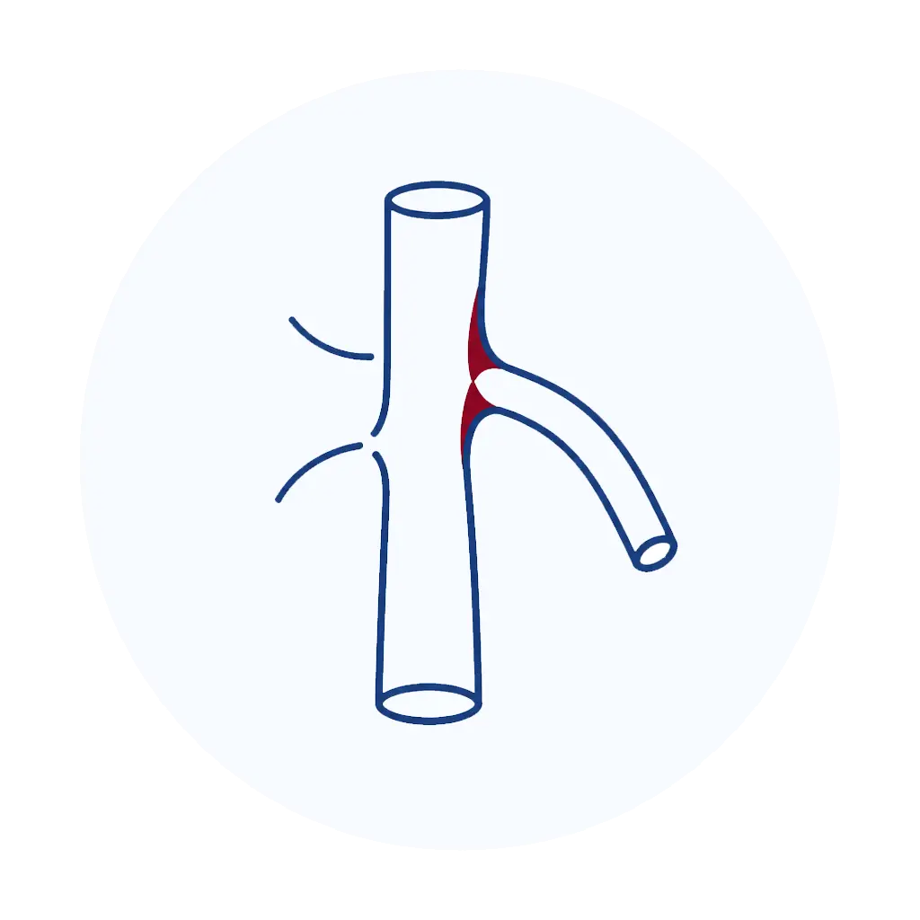 تنگی شریان sma